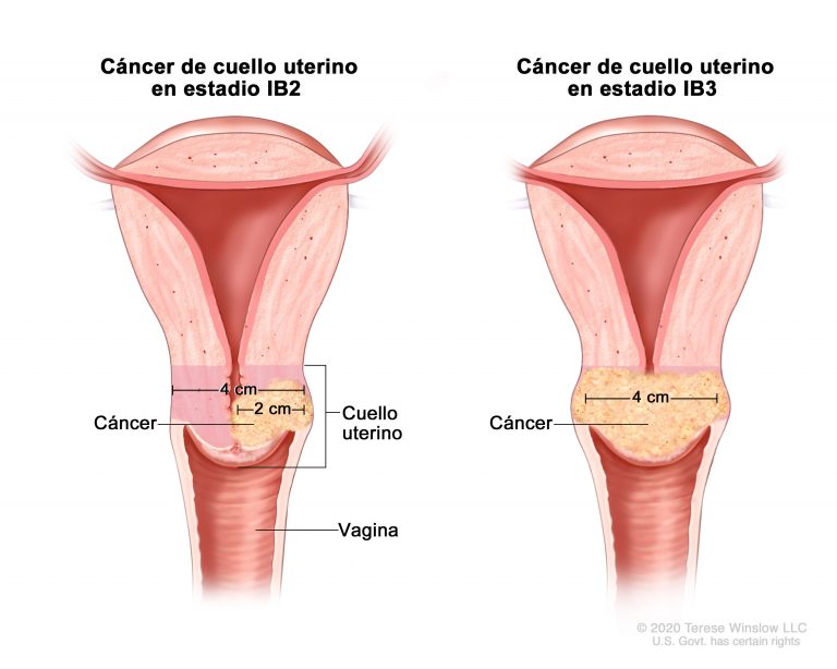 Retraso en la detección del cáncer de cuello uterino