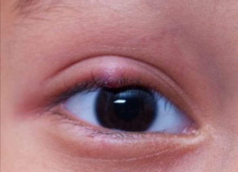 Los orzuelos y el maquillaje